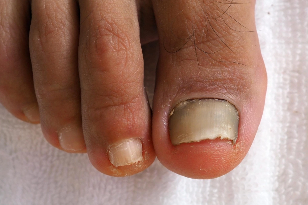 Infection Of Nails, Skin, And Bone