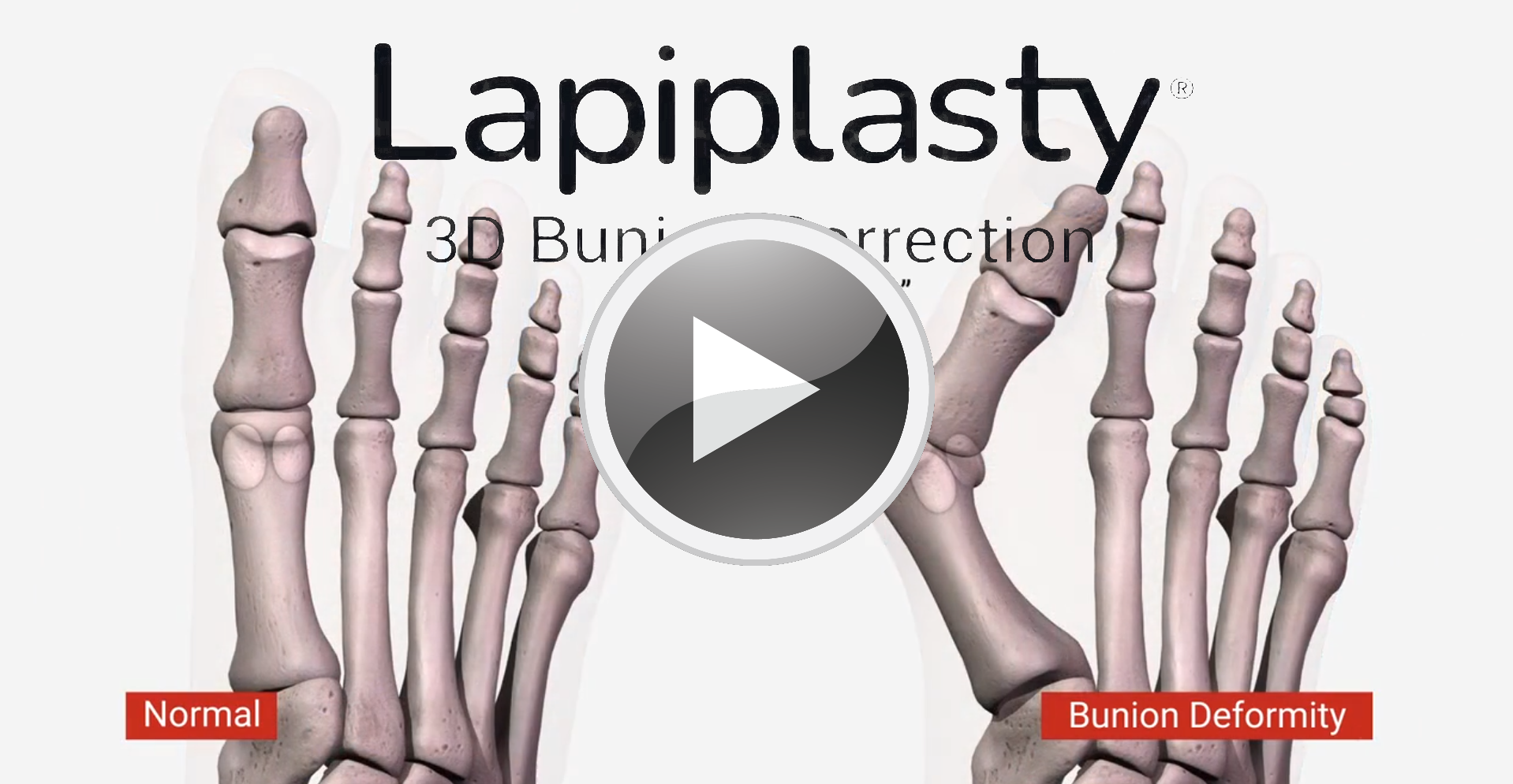 Lapiplasty Procedure