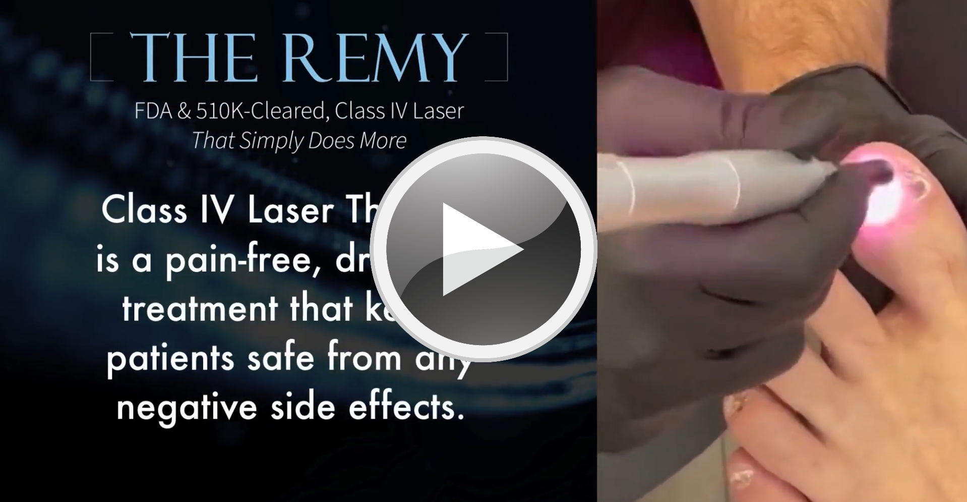 Remy Laser For Fungus